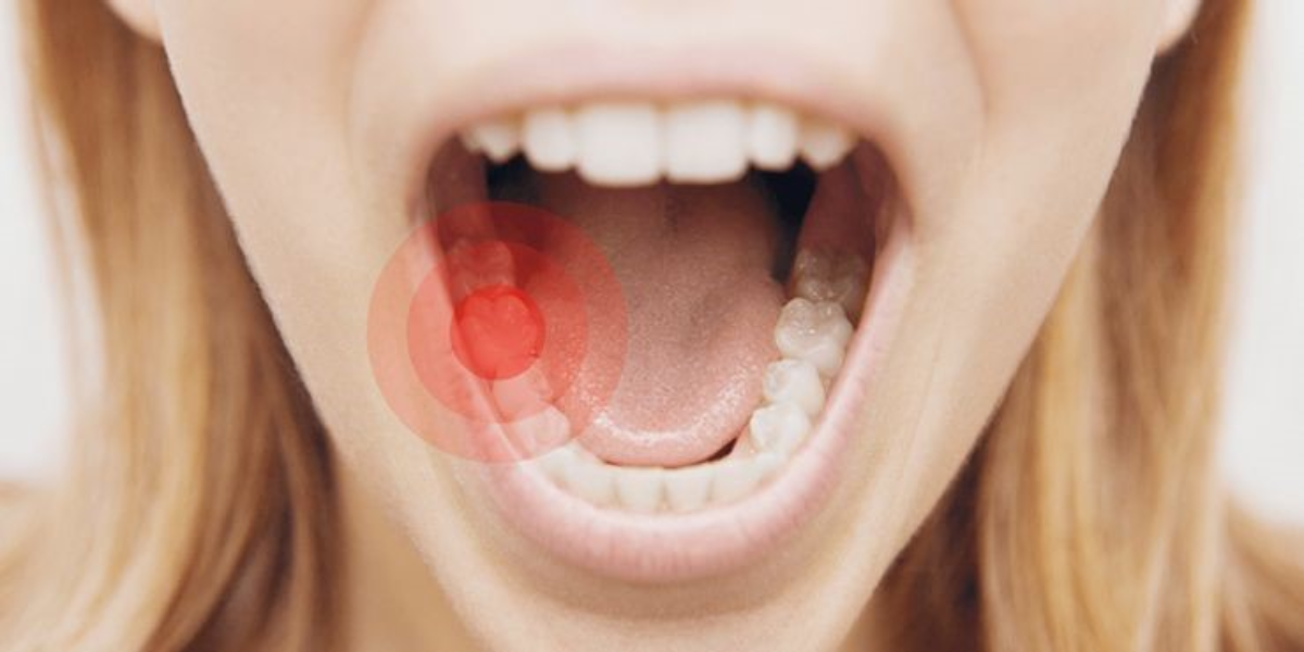درد ضربان دار دندان بعد از عصب کشی